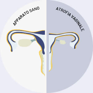 Atrofia Vaginale